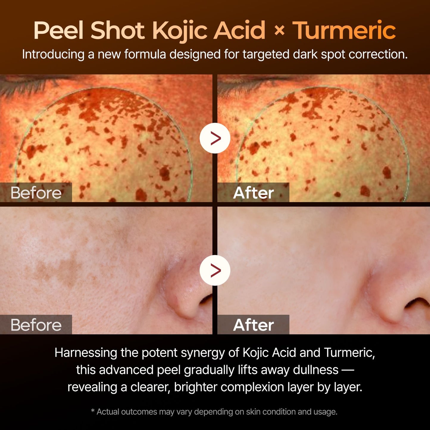 Dr.Melaxin Peel Shot Exfoliating Kojic Acid Turmeric Serum - 80ml