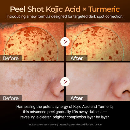 Dr.Melaxin Peel Shot Exfoliating Kojic Acid Turmeric Serum - 80ml